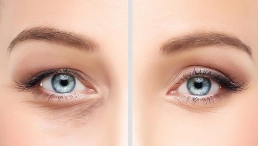 Göz Altı Işık Dolgusu ve Morluk Tedavisi